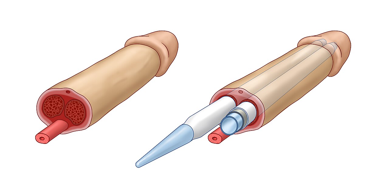 Prótese peniana depois do implante Um diagrama de um implante peniano inflável inserido no corpo cavernoso do pênis