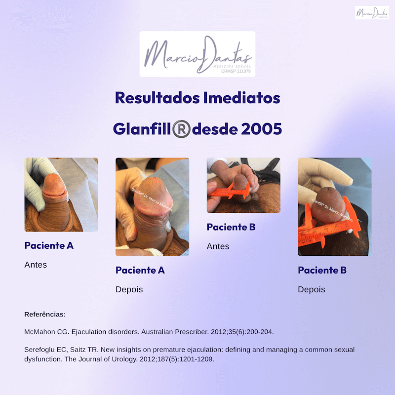 Resultados do aumento da glande com GlanFill® ácido hialurônico